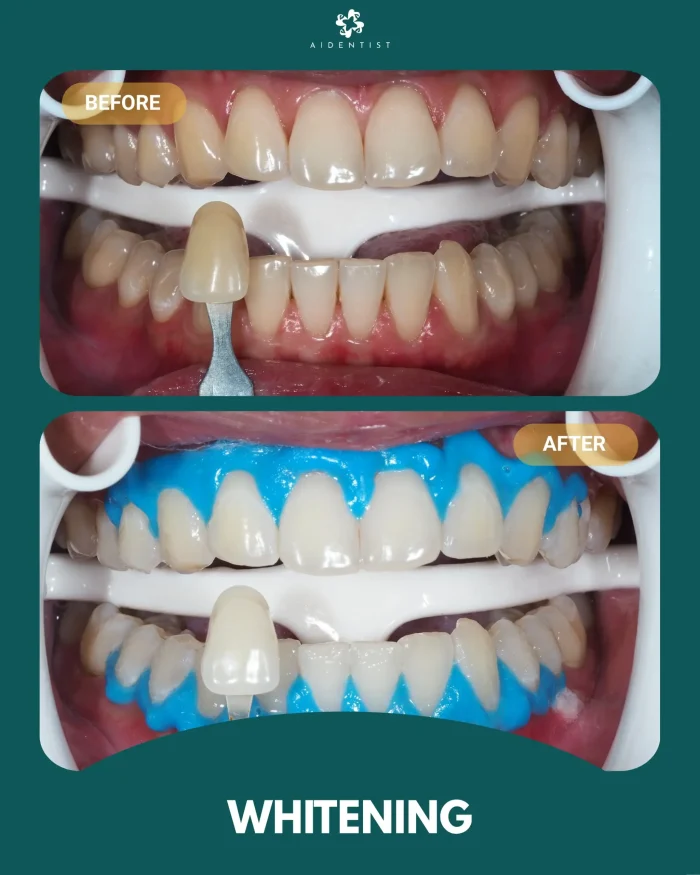 Whitening Testimoni 1