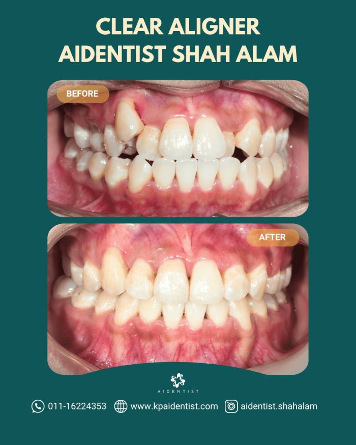 Clear Aligners Testimoni 1