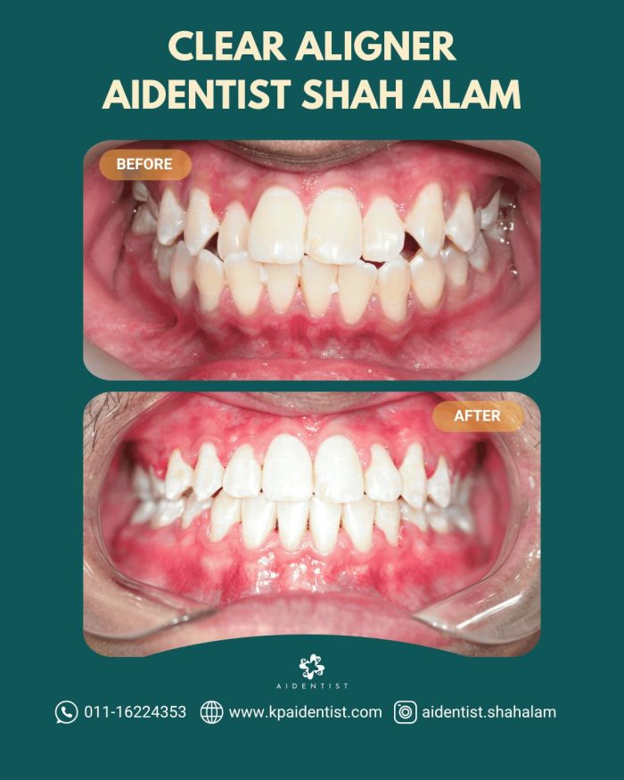 Clear Aligners Testimoni 2
