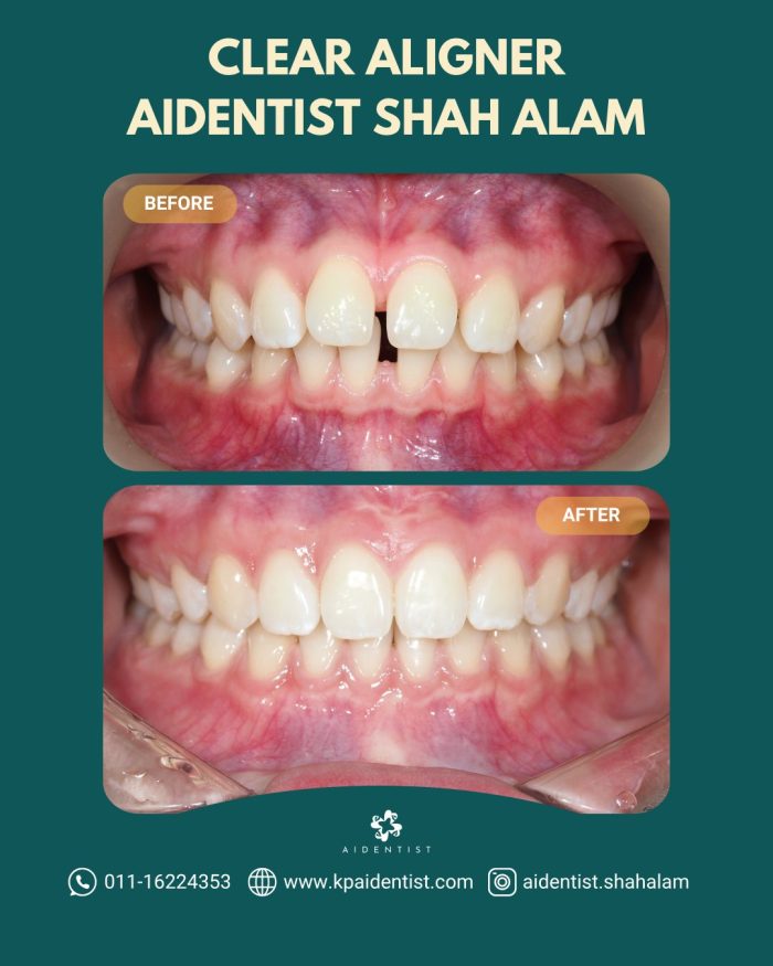 Clear Aligners Testimoni 3