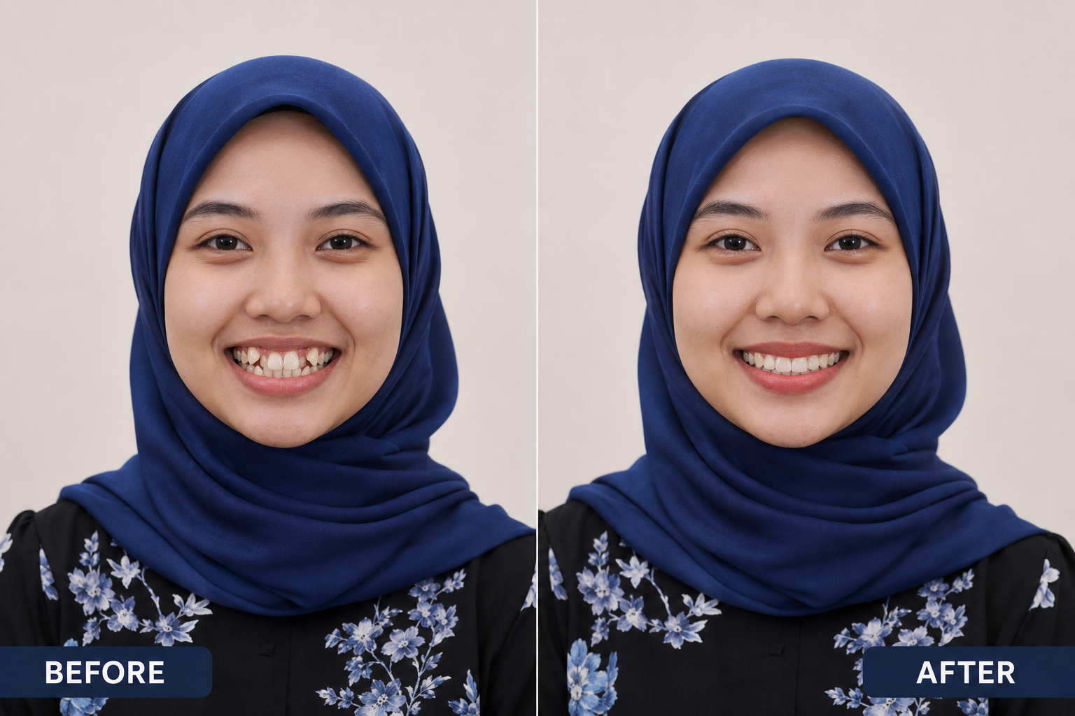 Braces before after