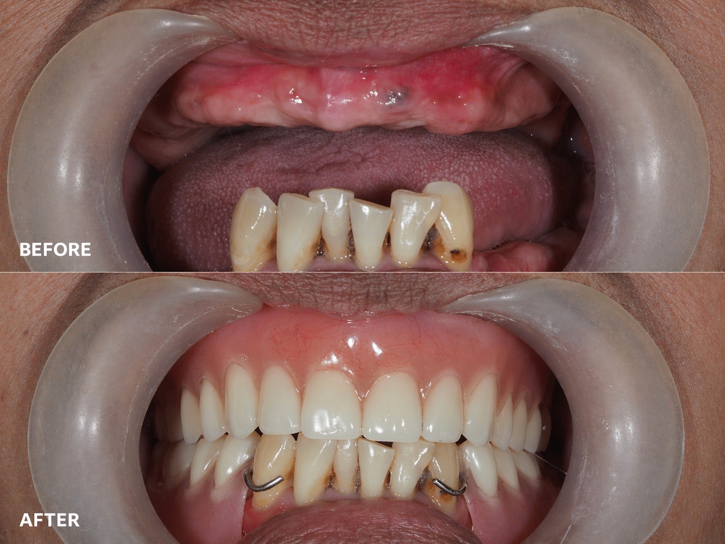 Dentures