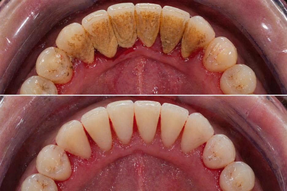 Scaling before after