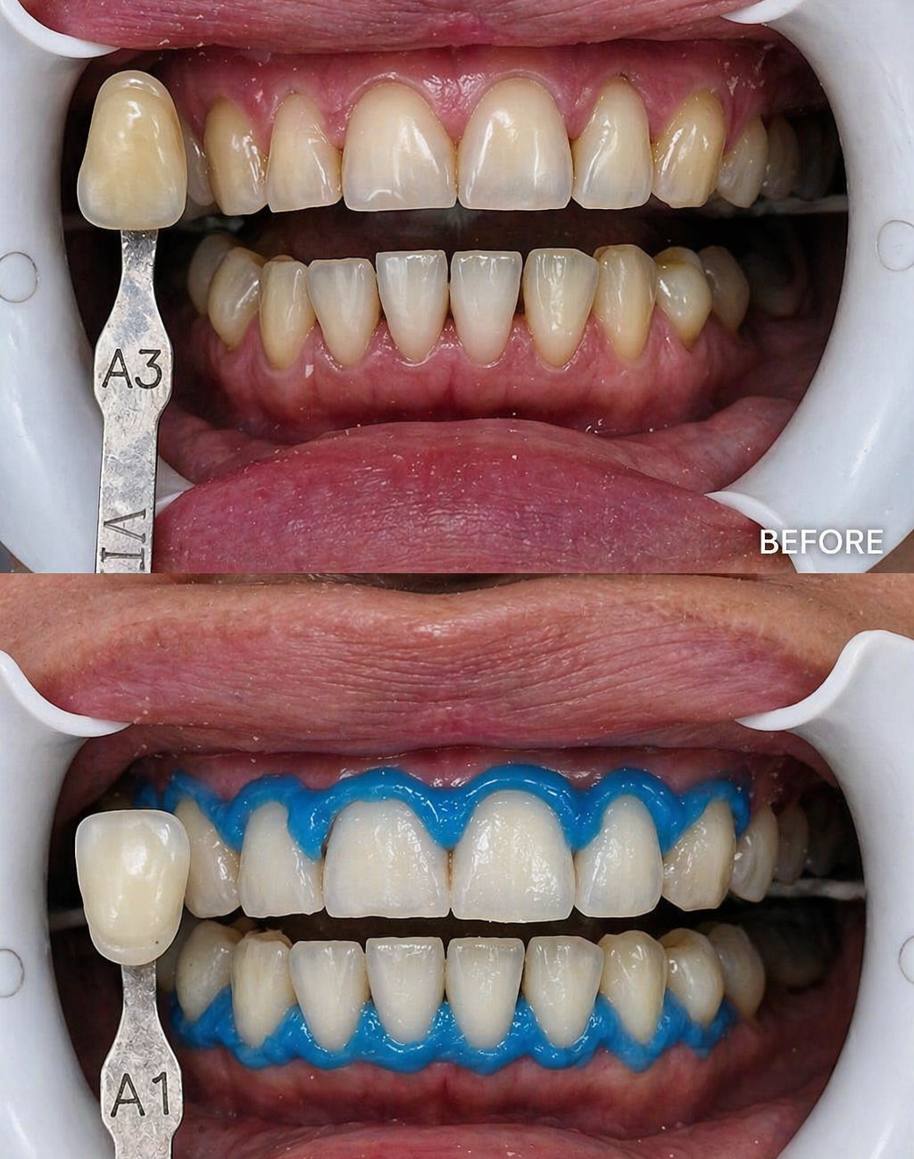 Whitening before after